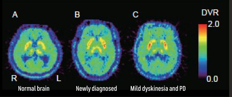 Human brain PET image showing density of adenosine A2A receptors